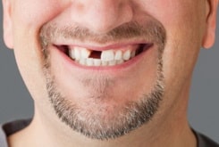 Почему нужно ставить протез на место отсутствующего зуба