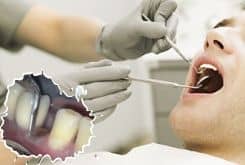 Нужно ли удалять корни разрушенных зубов?