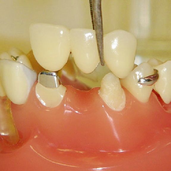 Cъемное протезирование зубов