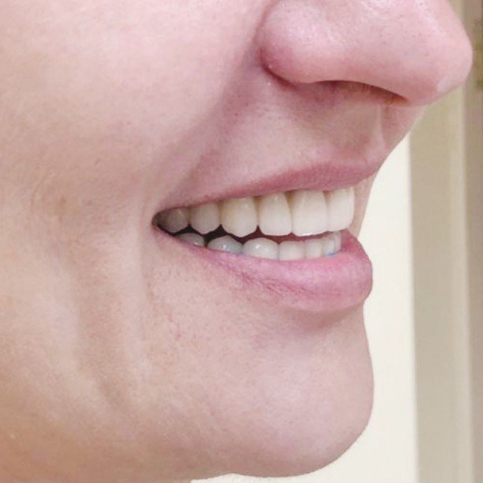 Имплантация и полное восстановление 28 зубов