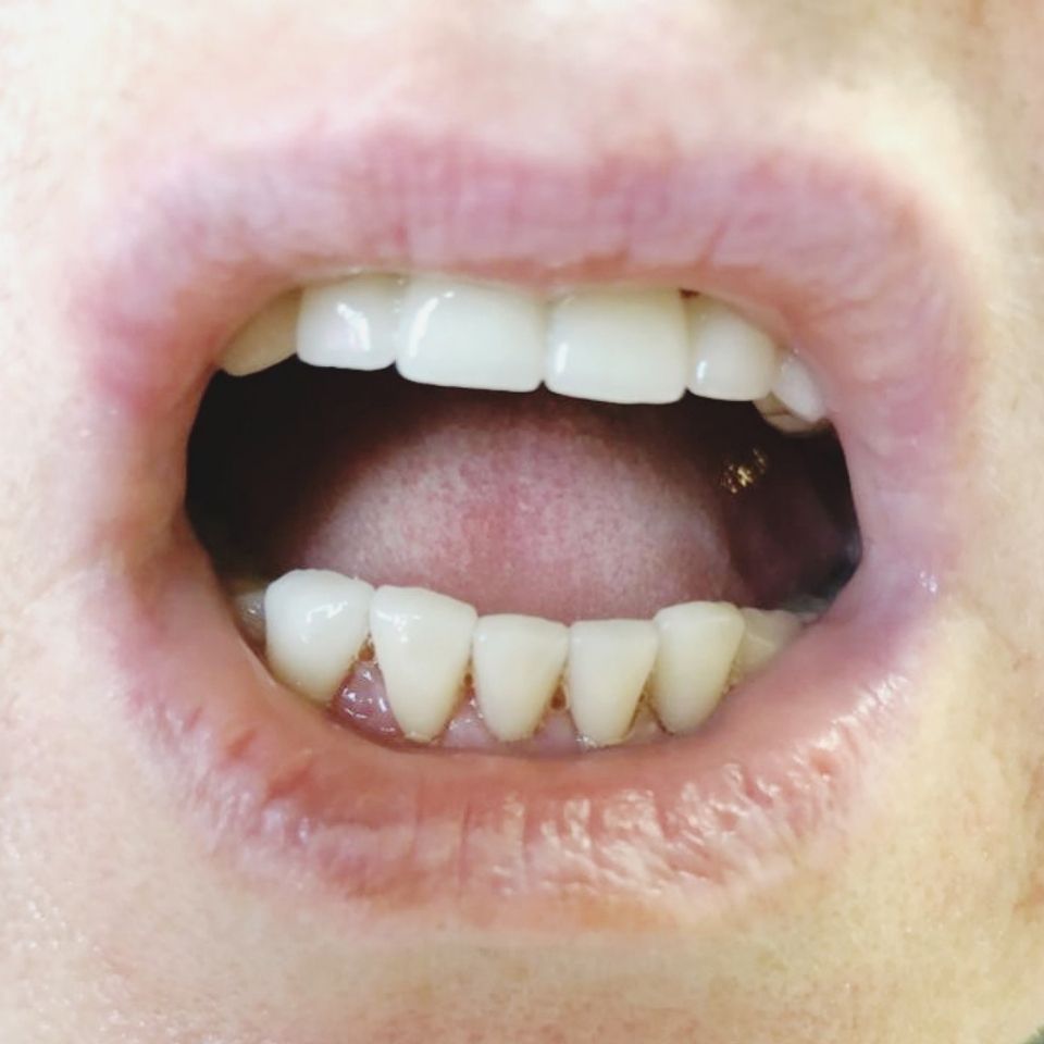 Полное восстановление всего зубного ряда с имплантацией.