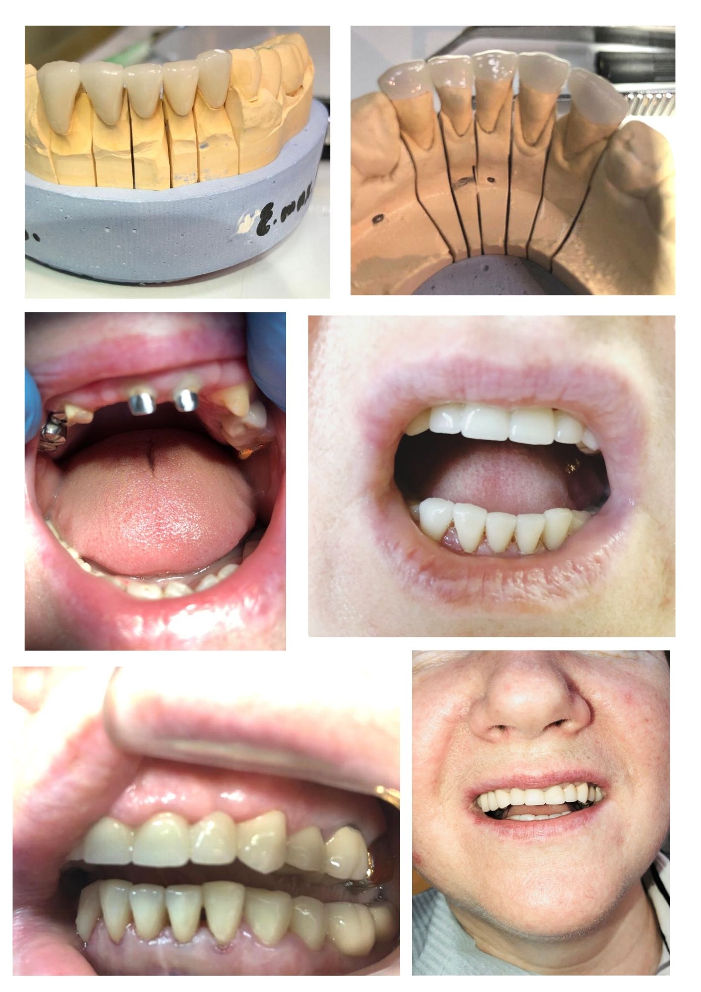 Полное восстановление всего зубного ряда с имплантацией