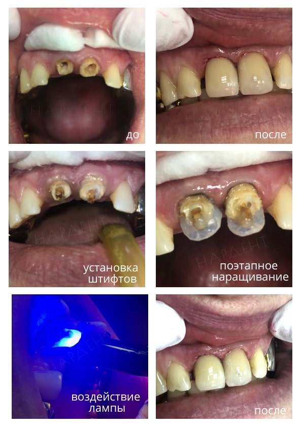 Реставрация передних зубов прямым методом за одно посещение
