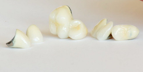 Протезирование зубов в московской клинике Нардент