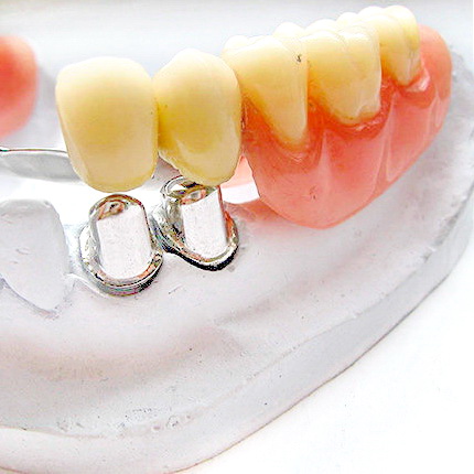 Комбинированное протезирование зубов