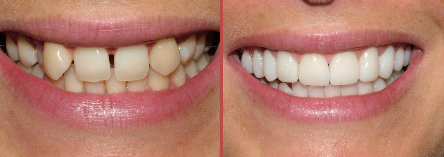 Реставрация зубов: до и после